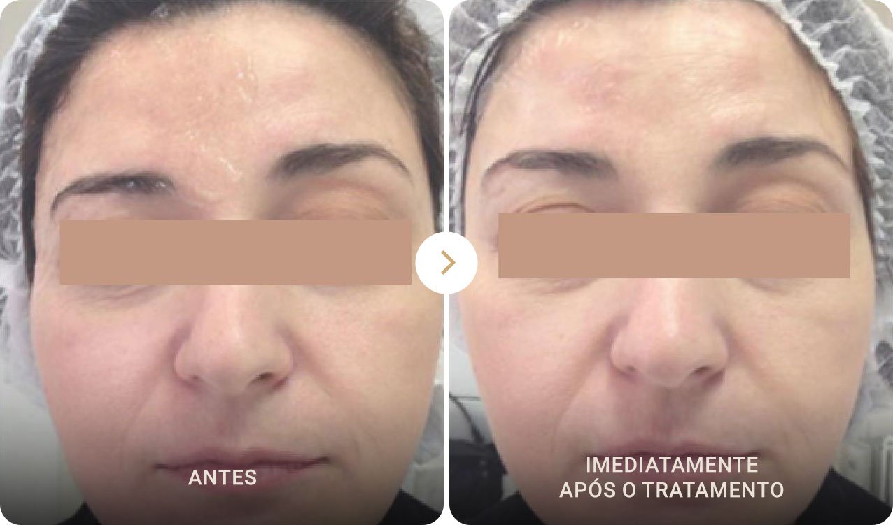 Resultados do ultraformer para bigode chinês