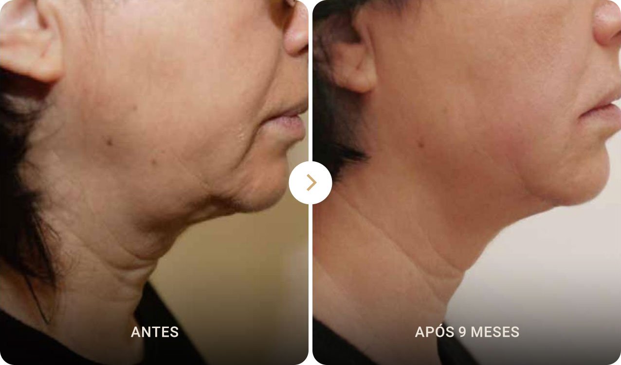 Resultados do ultraformer na papada