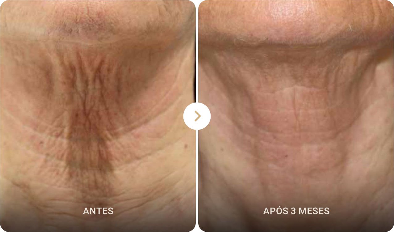 Resultados do ultraformer no pescoço