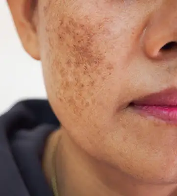 Tratamento para Melasma​
