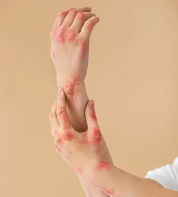 Tratamento de psoríase