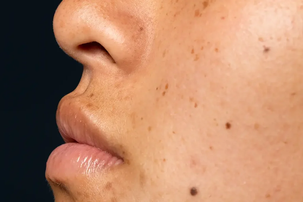 Melasma tem cura? O que ajuda a tratar e a controlar as manchas