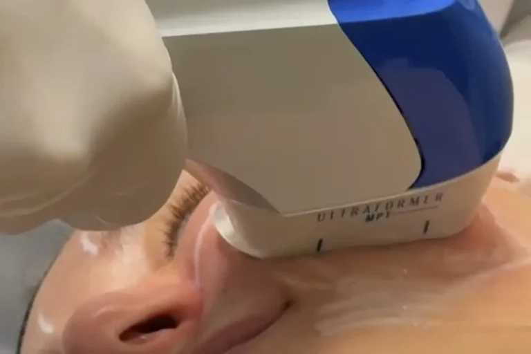 Entenda a diferença entre Ultraformer e bioestimulador de colágeno, quando cada um é indicado para flacidez depois dos 40 e por que combinar.